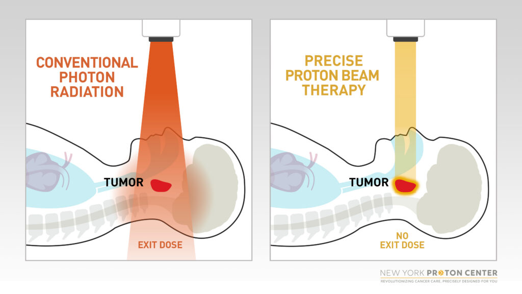 Unlike conventional photon radiation (left graphic), proton beams (right graphic) can be customized to travel to a specified depth in the body and then stop. Nearly all of the radiation is deposited directly into the tumor, with no exit dose, resulting in fewer side effects.